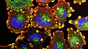 Metastatic-Melanoma-Cells